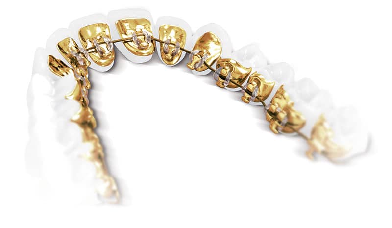 Incognito hidden braces mounted on the tongue-side of the teeth on a dental model